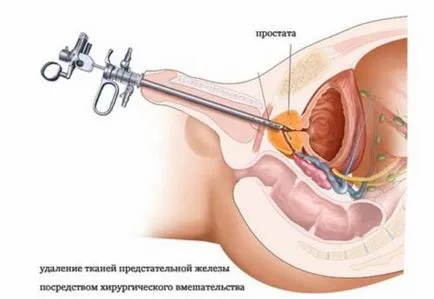 Tratamentul prostatitei medicamente eficiente și metode moderne