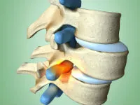 gerinc Listez (antelistez, retrolisthesis) kezelésére, okai, tünetek