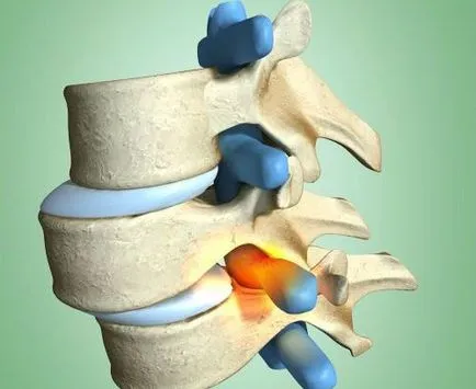 gerinc Listez (antelistez, retrolisthesis) kezelésére, okai, tünetek