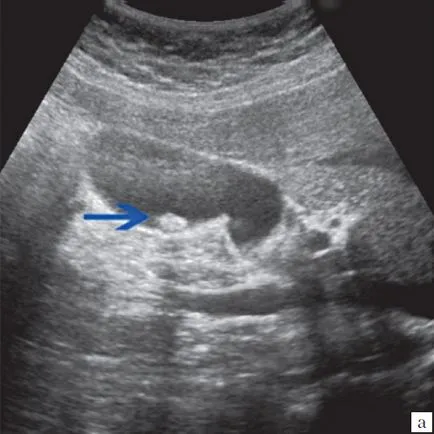 Радиални диагностика на патология на жлъчния мехур и жлъчните пътища - около kurzantseva