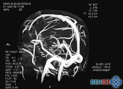 Магнитно-резонансна ангиография (MRA) и ядрено-магнитен резонанс характеристики на
