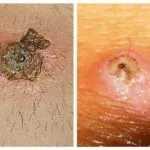 Myiasis ce este, pielea, intestinale, tip orală a unei persoane, foto și video