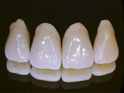 fém-kerámia fogak