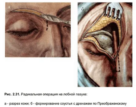 Методи за ефективно лечение на хроничен синузит