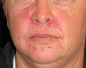Az atópiás dermatitis - okai, tünetei és népi jogorvoslati kezelésére neurodermitis