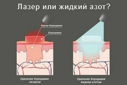 Fonalas papilloma kezelésére és megelőzésére betegségek