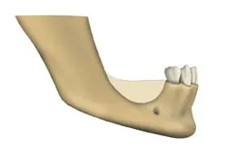 Informații generale despre implanturi dentare