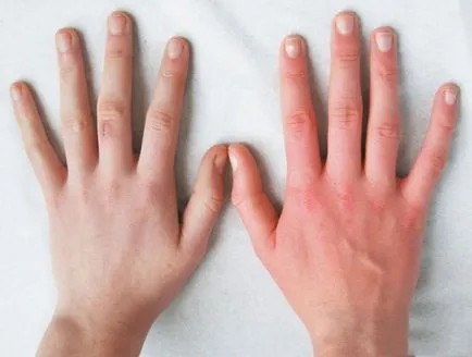 Frostbite ръце, които правят измръзване пръстите лечение на народната медицина