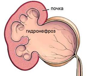 Funcționarea în hidronefroză și metodele de intervenție renale etapa zhirurgicheskogo