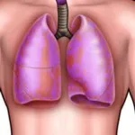 Усложнения при пациенти с COPD, ефектите на болестта