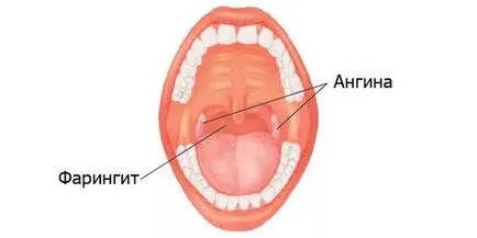 simptome edem laringian, simptome, cauze, tratament