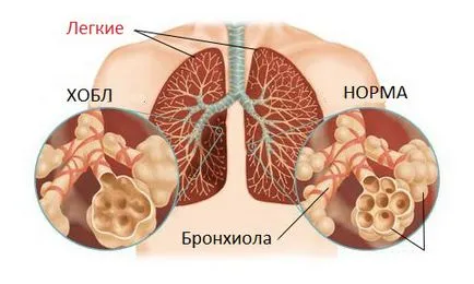 Szövődmények COPD, a hatását a betegség