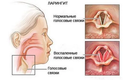 Оток на ларинкса симптоми, симптоми, причини, лечение