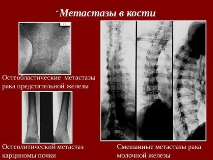 Osteoblaste și metastaze osteolitice