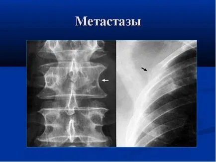 Остеобластна и остеолитични метастази