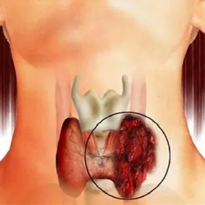 Първите признаци на рак на щитовидната жлеза чрез ултразвук, про shchitovidku