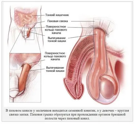 hernie inghinală la copii cauze, simptome, diagnostic si tratament - sectiune medic pediatru - ziar