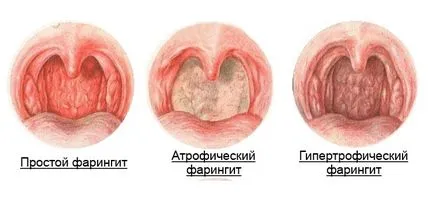 ardere continuă în gât, durere, tuse, râgâie, provoacă uscarea, tratamentul