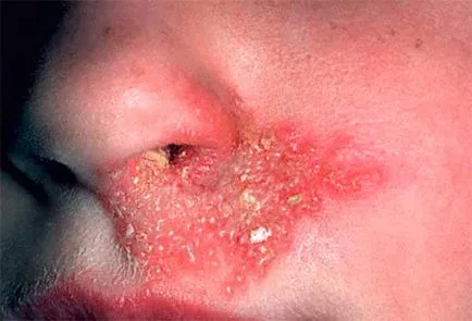 Вредата (травма) на носа - химична изгори носа, лечение в Москва