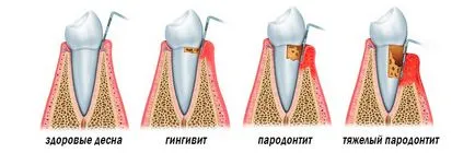 Okai periodontális betegség, a svájci Implant Clinic - fogászati ​​implantátumokat