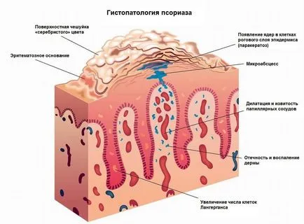 Okai psoriasis fejlesztési szakaszban és a modern kezelési eljárások - egészségügyi portál „”