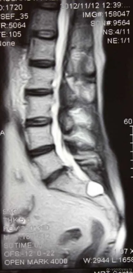 Пример динамичен interspinous стабилизиране на гръбначния стълб след microdiskectomy
