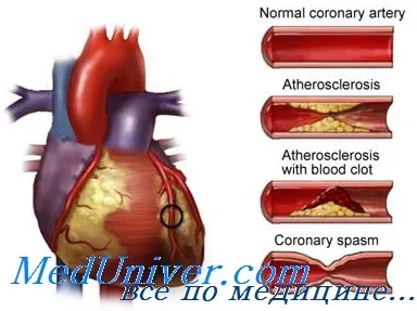 Рискът от коронарна артерия байпас