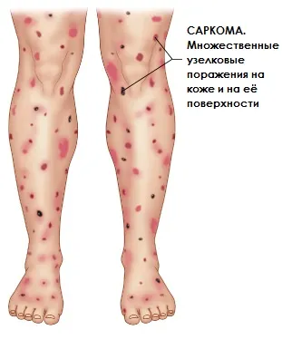 Kaposi-szarkóma okoz, a tünetek és a kezelés, diagnózis Kijev