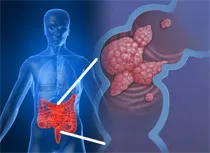 Simptomele de cancer de stomac și intestine