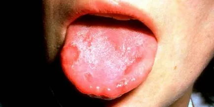 Симптоми и признаци на стоматит при децата в устата, на езика, устните, гърлото (снимка)