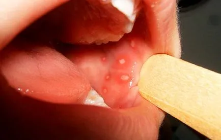 Simptome și semne de stomatită la copii în gură, pe limbă, buze, gât (foto)
