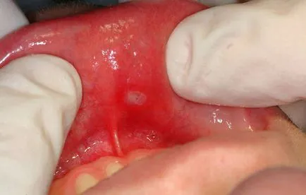Симптоми и признаци на стоматит при децата в устата, на езика, устните, гърлото (снимка)