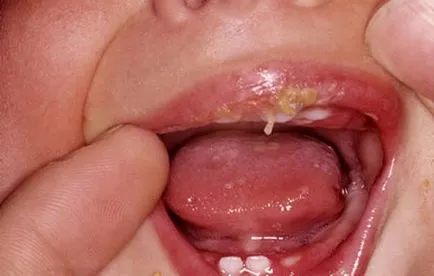 Simptome și semne de stomatită la copii în gură, pe limbă, buze, gât (foto)