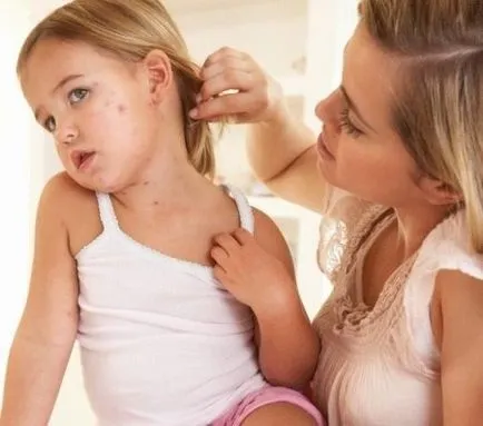 Câte zile de varicela este contagioasa - fie sanatoasa