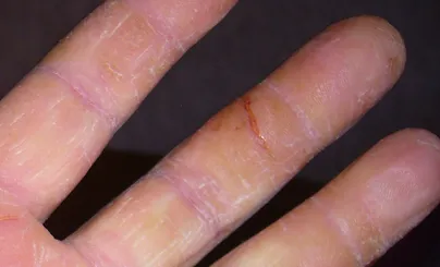 Száraz és repedezett bőr kéz fotó, okok, kezelés, gombás betegségek