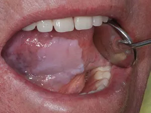 Aureus в устата при възрастни и деца, и на причините за симптомите, снимки и диагностика методи