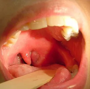 Aureus в устата при възрастни и деца, и на причините за симптомите, снимки и диагностика методи
