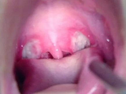 Aureus în gură la adulți și copii, precum si cauzele simptomelor, fotografii și metode de diagnosticare