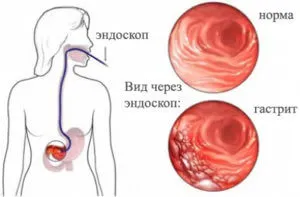 Görcse a gyomorban - okai, tünetei, kezelése