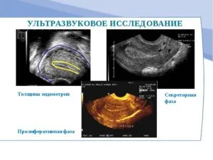 Grosime norma hiperplaziei endometriale și abaterea de la ea