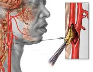 A vérrög a nyaki verőér, annak okai és következményei