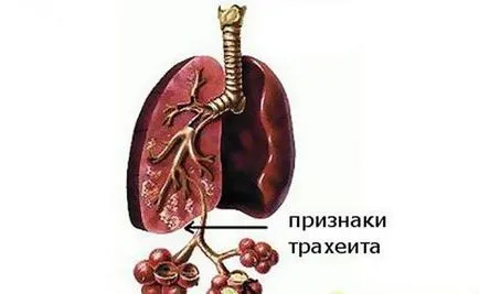 Трахеит и бронхит симптоми и лечение на деца и възрастни с антивирусна, антибиотик,