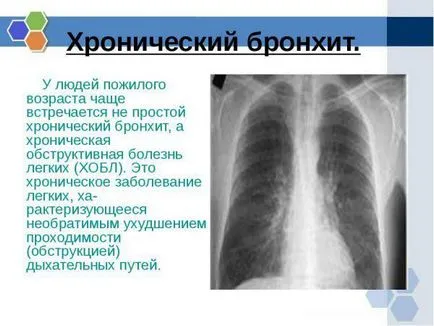 Трахеит и бронхит симптоми и лечение на деца и възрастни с антивирусна, антибиотик,