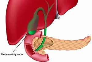 Уплътняване стени на жлъчния мехур, което е причина - живеят здравословно