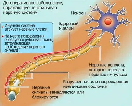 Yusupov Spitalul, București, scleroză multiplă apare ca un modul de a recunoaște modul de a trata