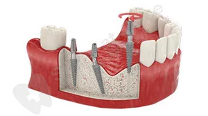 A fogászati ​​implantátum az azonnali terhelésre, mik az előnyei