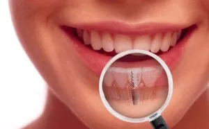 A fogászati ​​implantátum az azonnali terhelésre, mik az előnyei