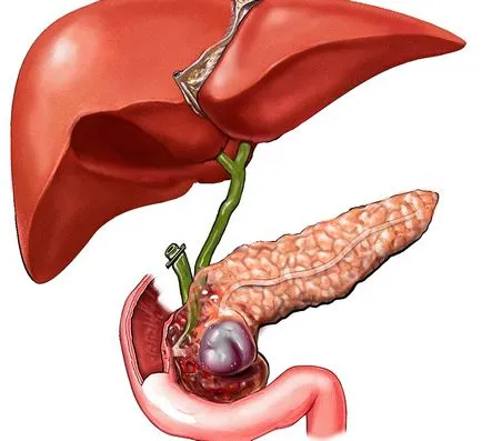 Жлъчката в панкреаса - акценти, леене, стагнация