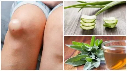 5 най-добри противовъзпалителни средства за отстраняване на течност от коляното