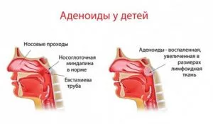 Аденоиди в детските симптоми, признаци и причини за